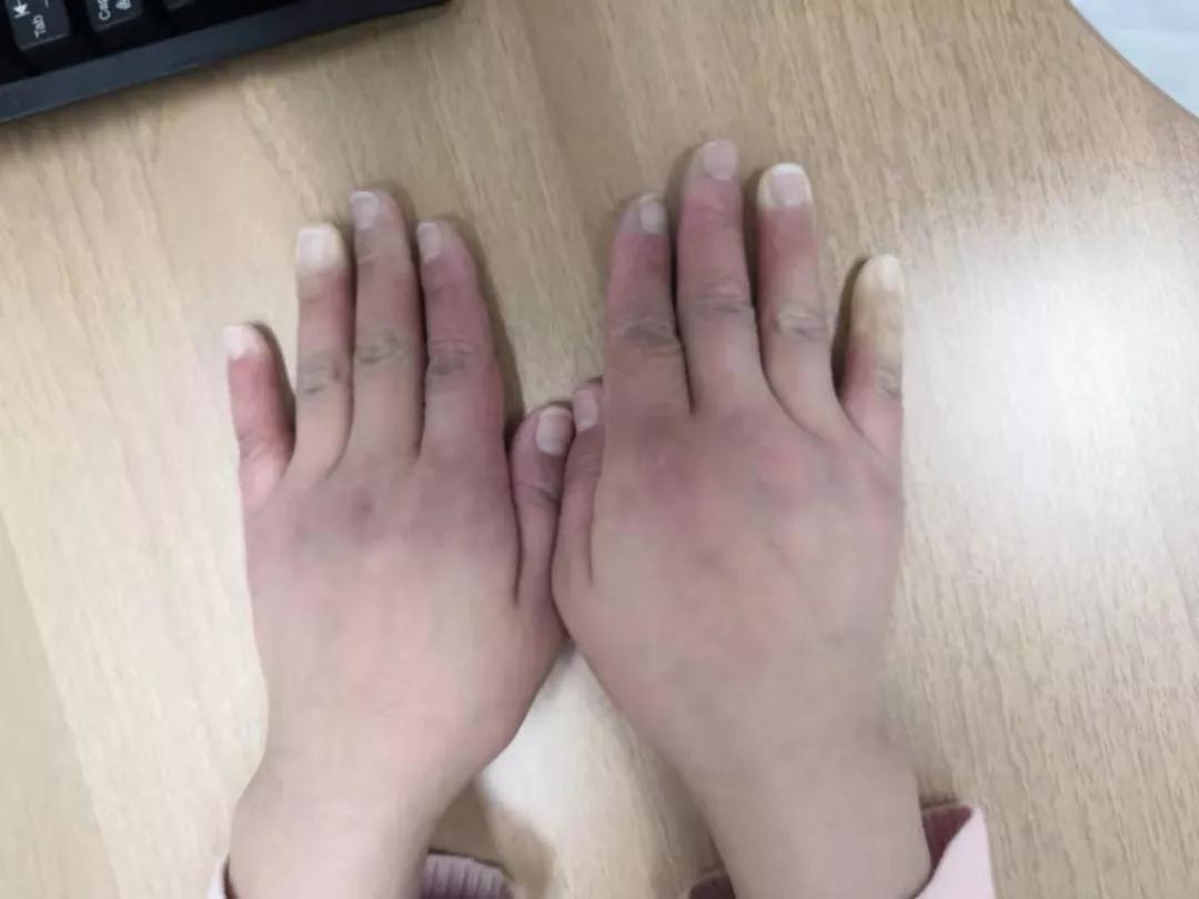 “手指、腳趾發(fā)白、發(fā)紫……”這些“小毛病”千萬(wàn)別大意