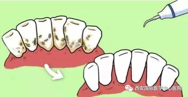 【科普】牙齒上的黃斑好難看，三招告訴你如何預(yù)防氟斑牙