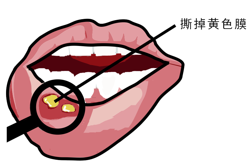 經(jīng)常口腔潰瘍，真的只是缺維生素嗎？