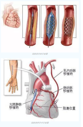 魚與熊掌不可兼得？冠脈雜交手術(shù)一站式解決問題