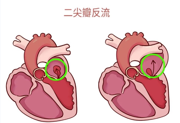 體檢報告里的心臟瓣膜返流，你讀懂了嗎？